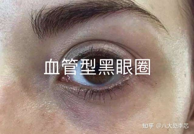 改善:如果由于下眼睑皮肤较白和较薄而使皮下血管明显呈黑眼圈