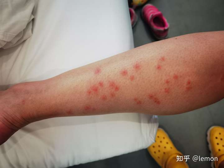 被毒蚊子咬后如何快速消肿止痒?