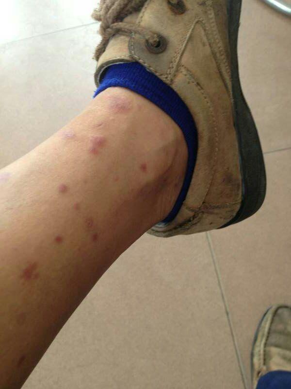 我爸吃了阿司匹林,一直过敏,挺严重的,他还死不肯去医院,还说花那个钱