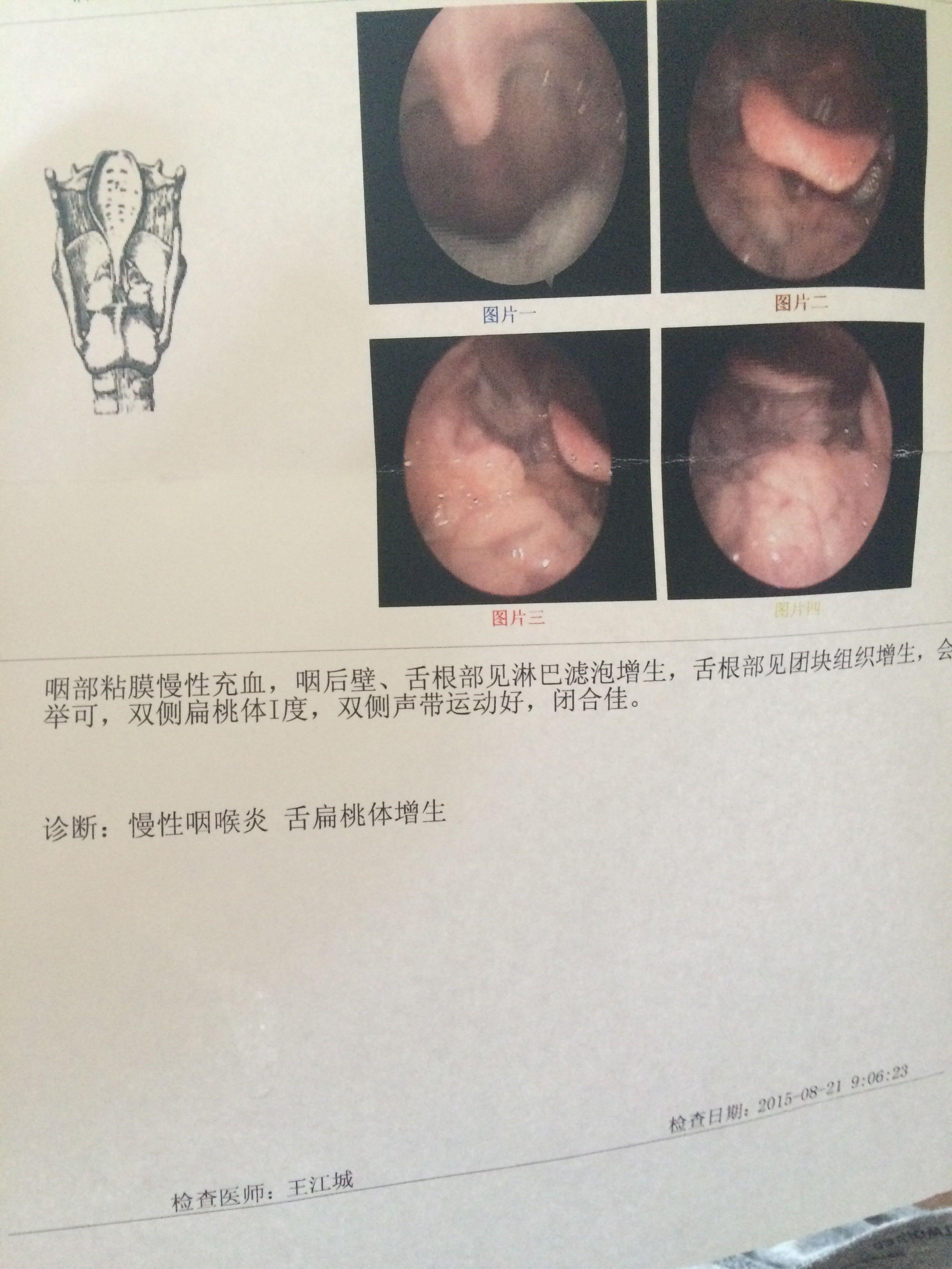 我有慢性咽喉炎两年了,之前诊断是慢性浅表性胃炎的并发症?