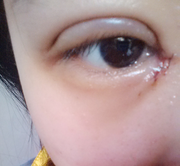 请问割双眼皮有什么危险吗?