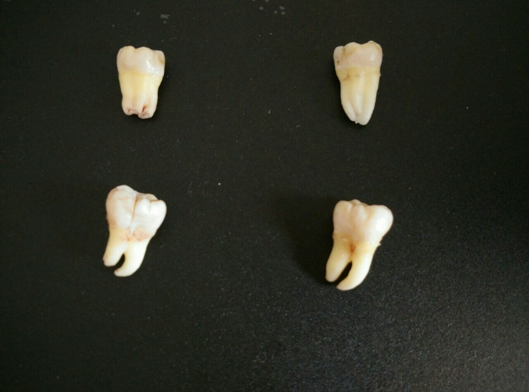1) 这是四颗智齿的全家福~ 图示位置为它们生前的位置╮(╯▽╰)╭