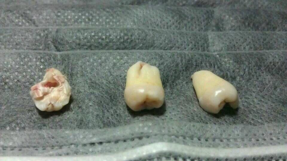 拔牙到底疼不疼?