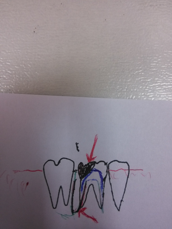 这种坏牙牙瘘管怎么处理好?