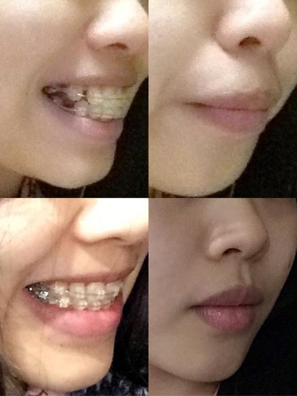 戴牙套后,我嘴形的变化,给你们看看对比图