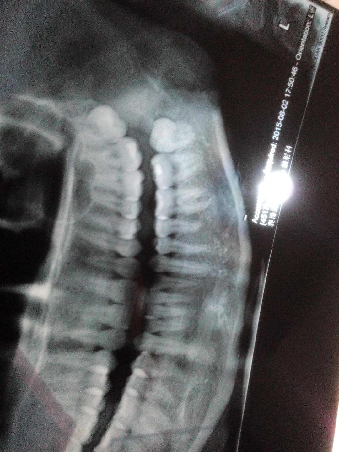 长了四颗智齿? - 王兴朝的回答 - 知乎
