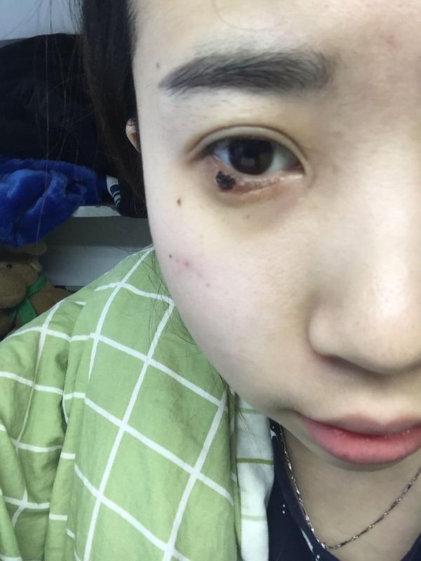 麦粒肿要多长时间好?