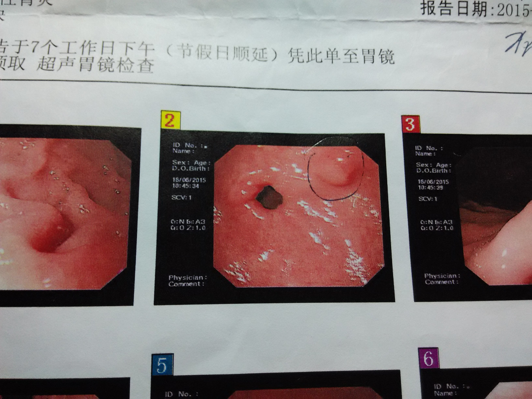 (胃窦)浅表粘膜慢性炎能自愈吗?