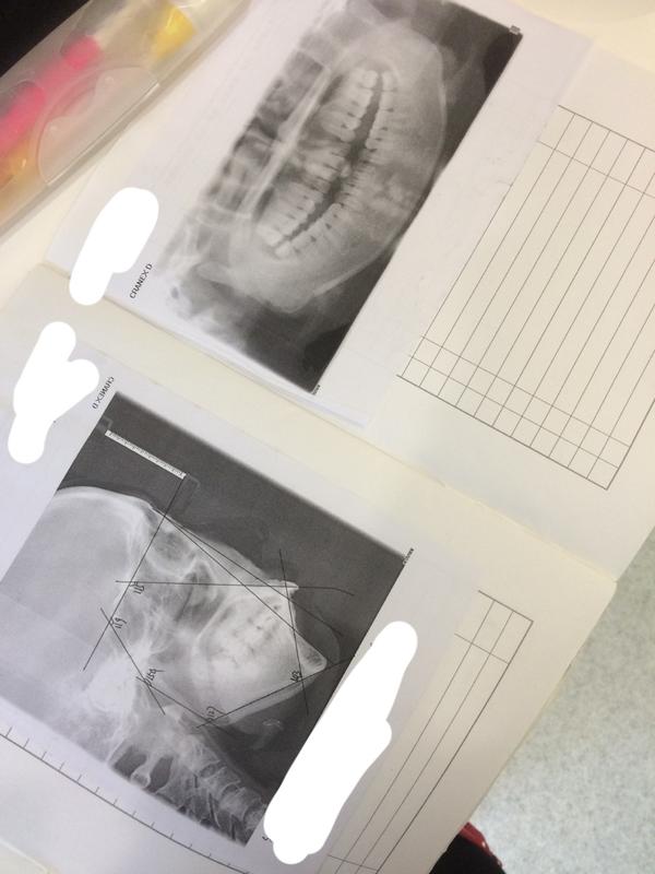 (这个是我的牙齿x光片,龅牙程度也看得很清晰.)