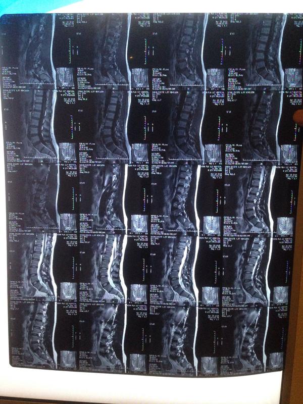 2年了一直觉得是腰椎间盘突出,可是核磁共振2次都显示正常.