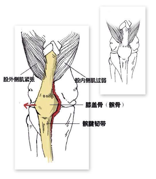 如图为:髌骨位置偏移