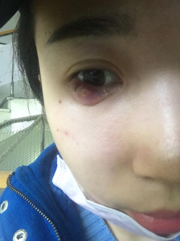 麦粒肿要多长时间好?