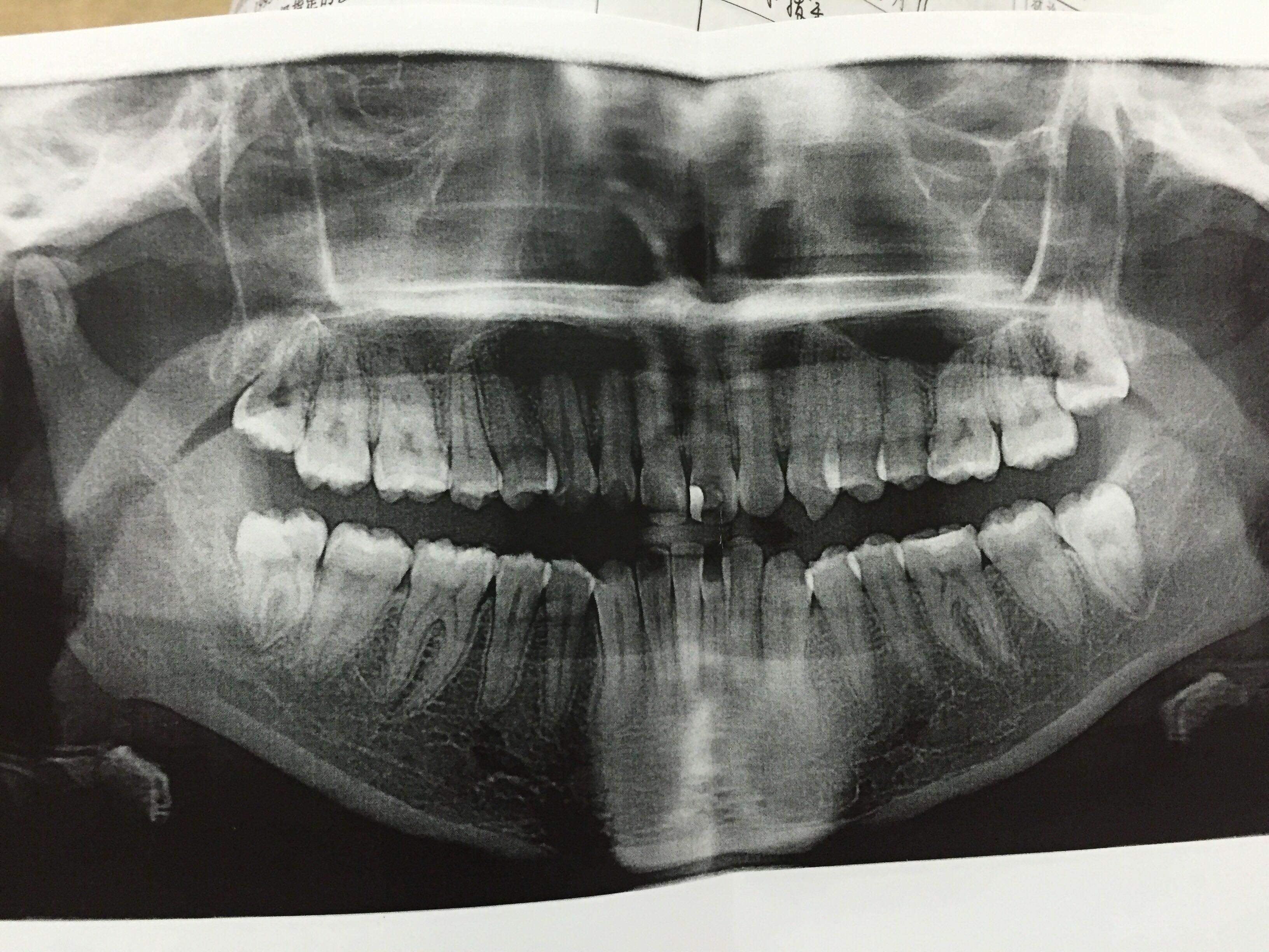 请问我的智齿是否需要拔?医生说让我自己选择
