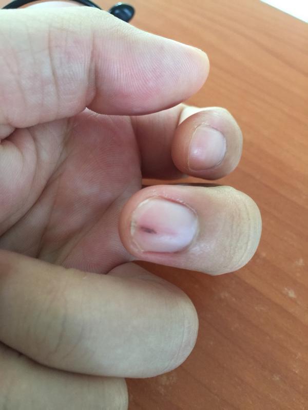 手指甲中间有一条深褐色纹路说明什么?
