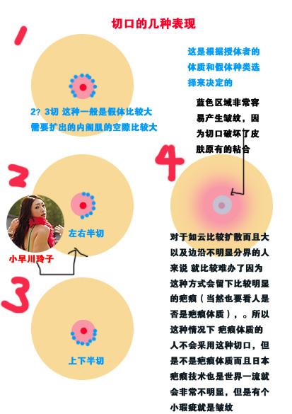 如何辨别真胸假胸?