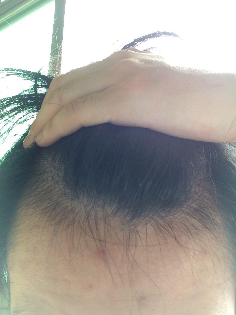 大三学生脱发有什么方法<em>恢复吗</em>? - Bryan LAI 的