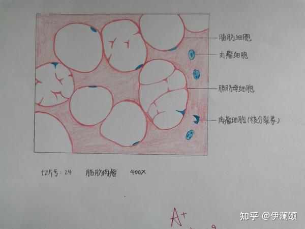 9,脂肪肉瘤(切片未观察到瘤巨细胞所以没画)