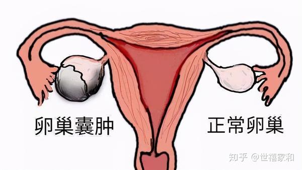大多数女性不知道应该如何治疗,到底该不该进行手术.