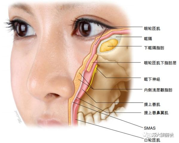 鼻颧沟的存在,可使眼眶下方出现明显的凹陷,不仅会导致明显的黑眼圈