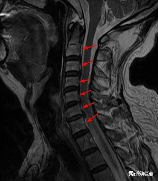 典型病例——颈椎后纵韧带钙化(mr)