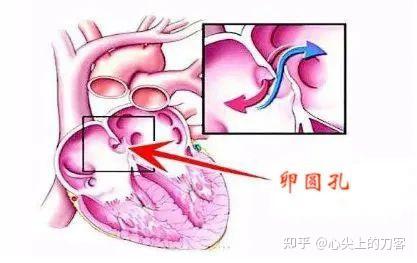 卵圆孔未闭,需要不需要治疗呢?