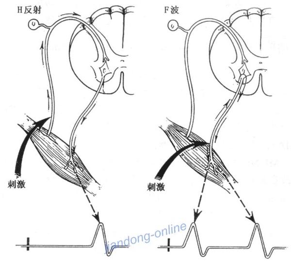 面神经的f波技术以及在面瘫中的应用