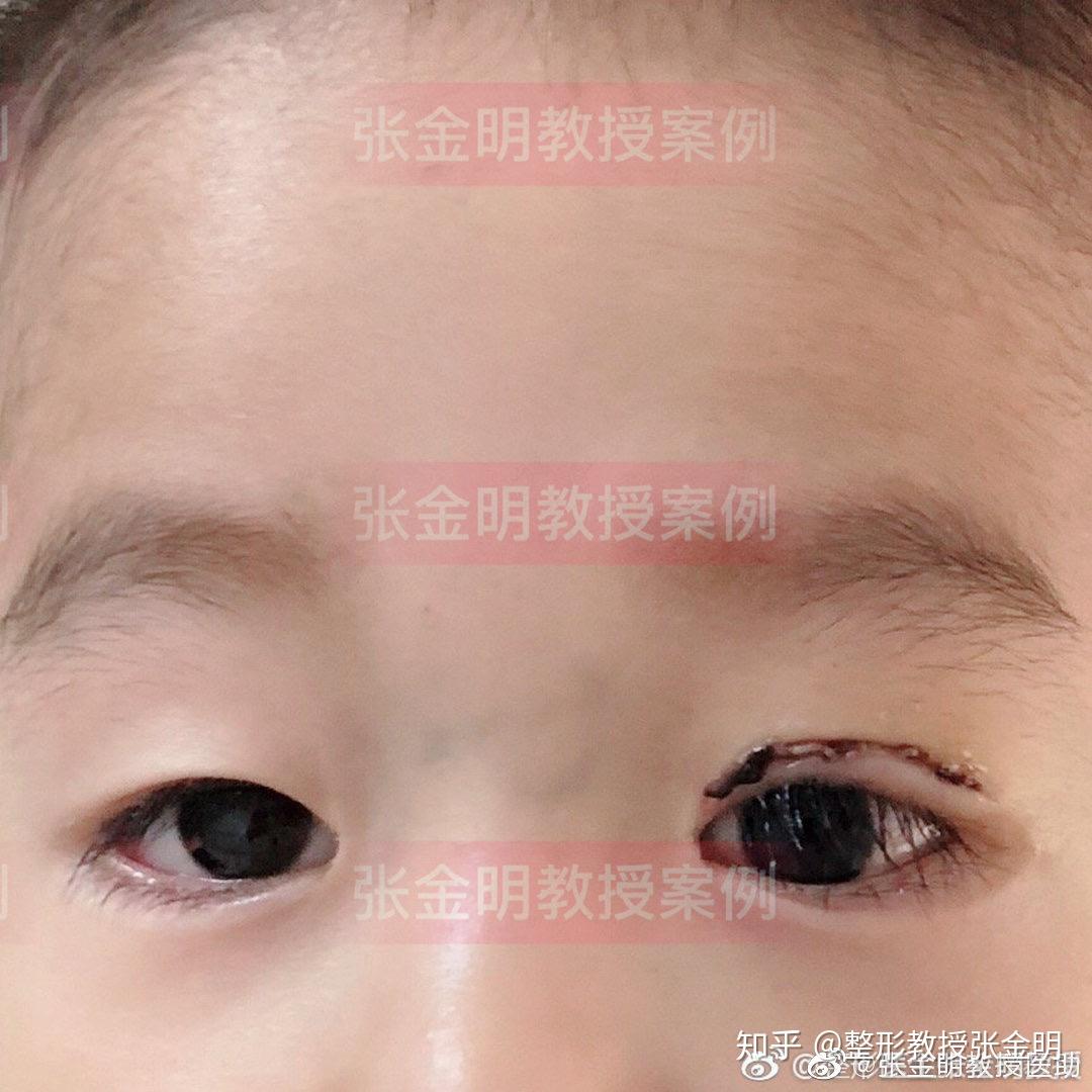 上,为防止弱视发生,应尽早手术;如为轻中度下垂,不影响儿童正常视觉