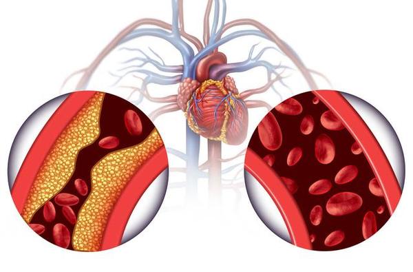 心肌缺血分5种不同心肌缺血治疗方法不同心血管专家说清楚