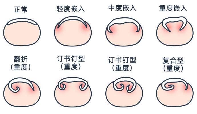 那天我的脚指甲长肉里了