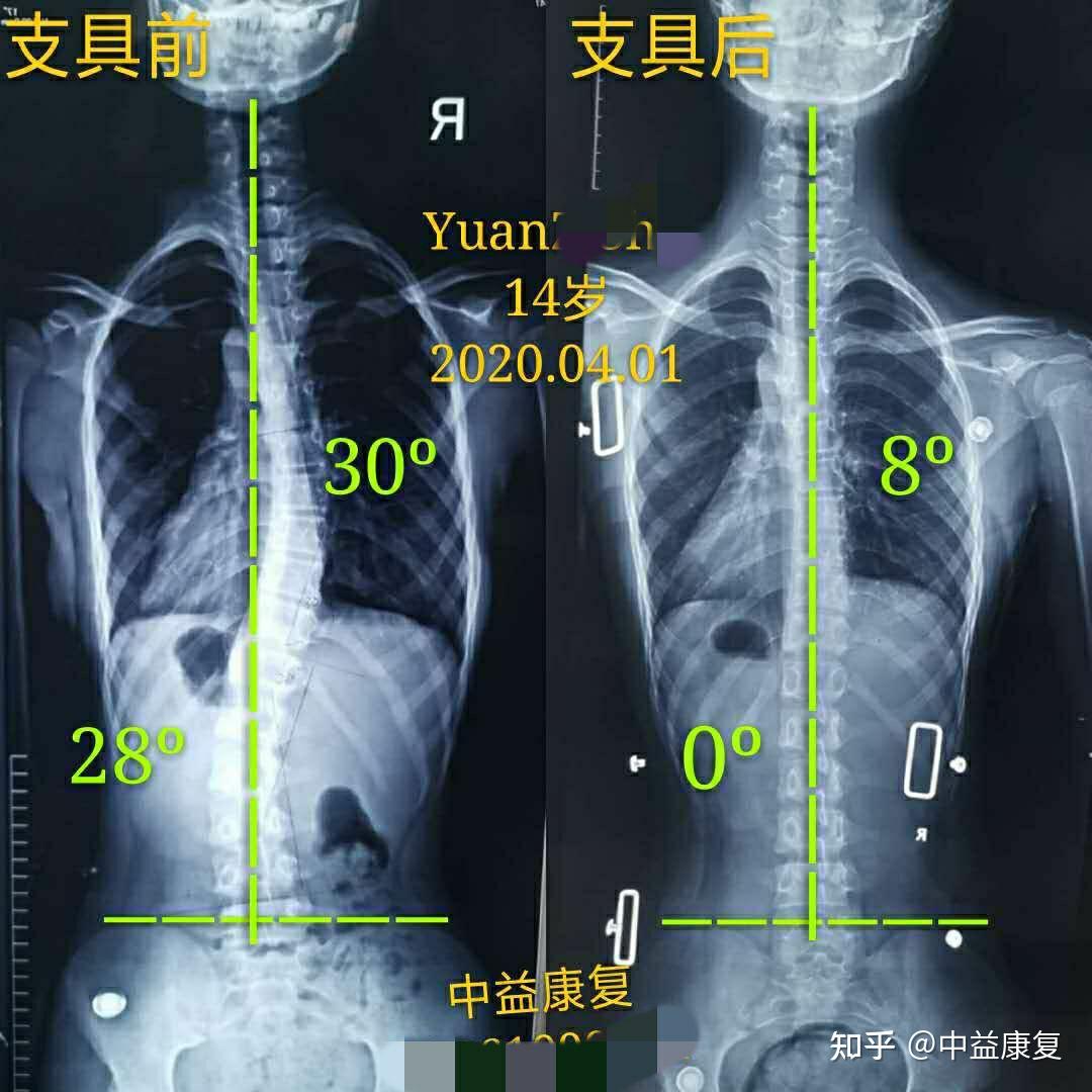 全国脊柱侧弯支具哪里做的好