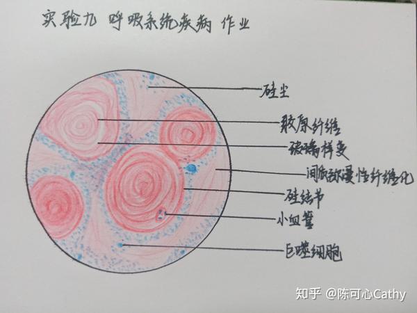发完就清相册啦~ 有不妥的地方还希望大家指正  一,肝细胞水肿 最后