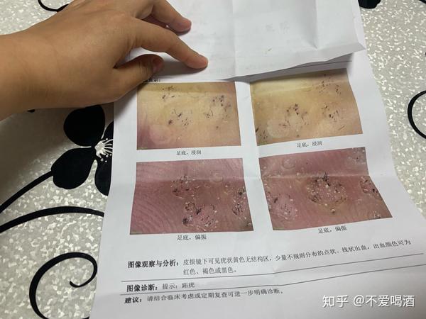 跖疣怎么治我历经冷冻各种药膏和方法终于摆脱了跖疣