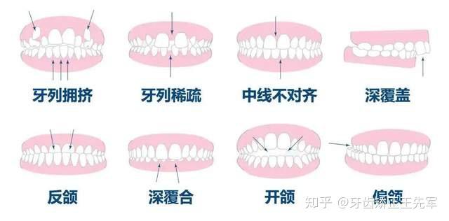 苏州牙齿矫正-如何判断咬合是否正常?