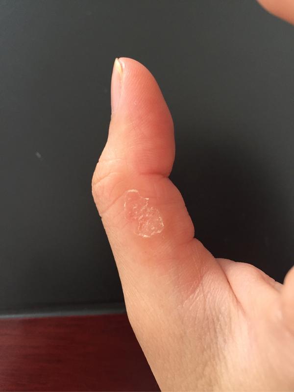 手指长水泡一直不好,是湿疹还是手癣还是神马?