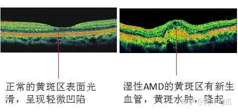 可以清晰显示眼底血管的状态,容易发现眼底的各项疾病,比如:黄斑水肿