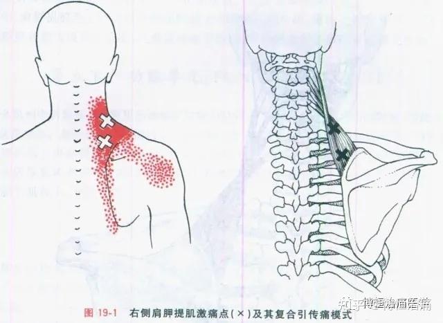 再看肩胛提肌损伤 知乎