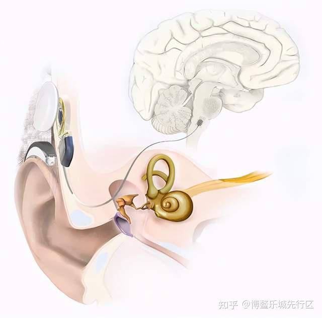 全球最先进的人工耳蜗在乐城可用已助力数百名患者重获新声