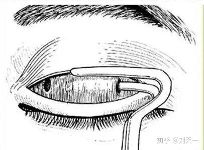 双眼皮提肌手术到底是什么?