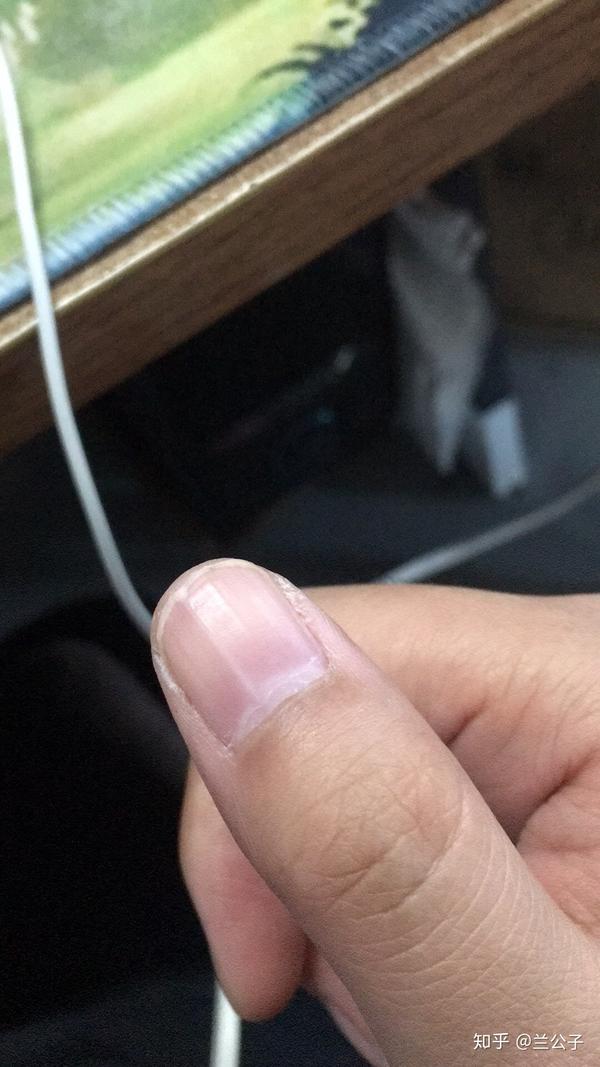 指甲内长白色竖条(随指甲生长)是什么原因,是否影响健康?