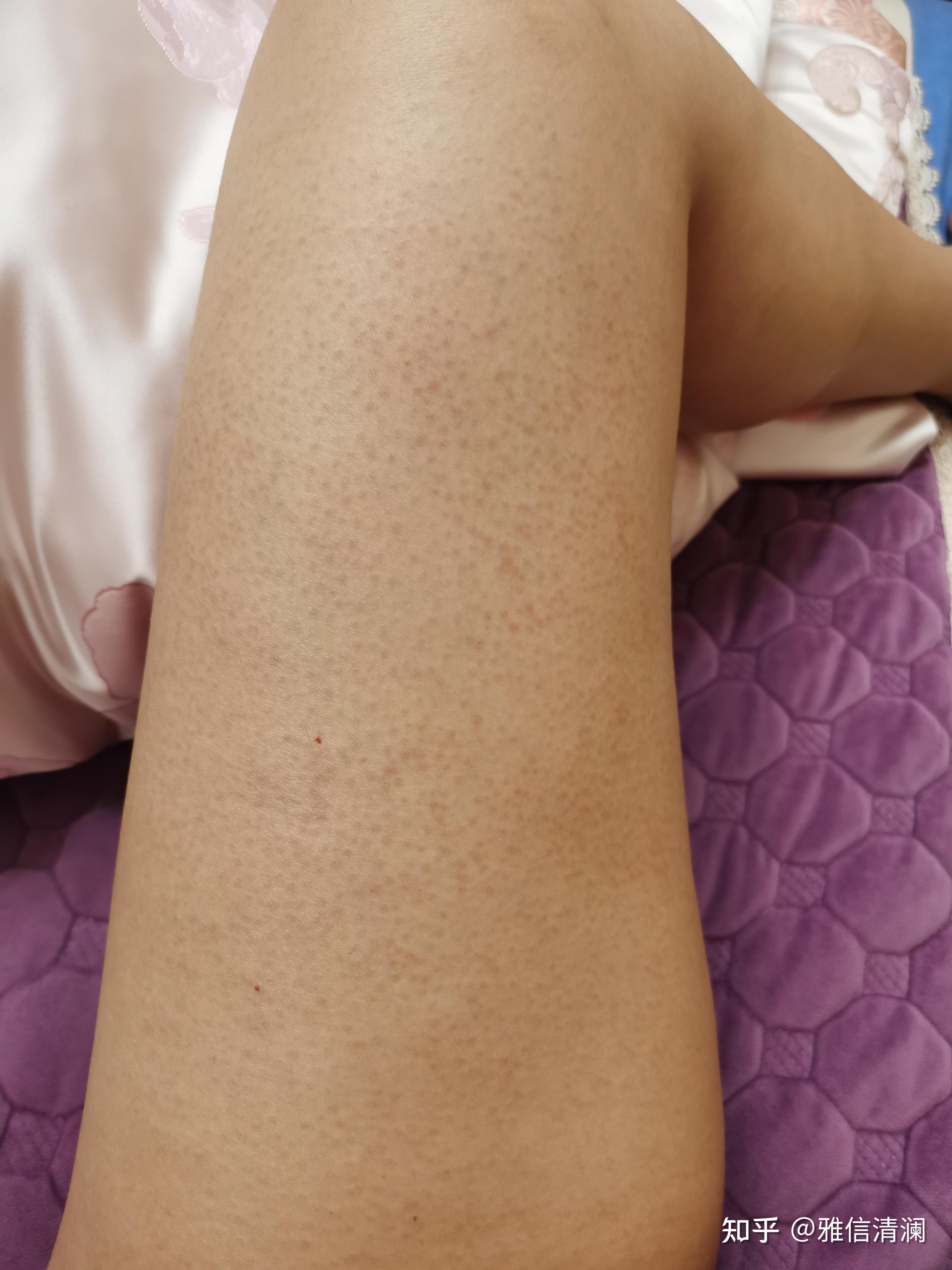 毛周角化症鸡皮肤本质上究竟是什么导致的能改善吗