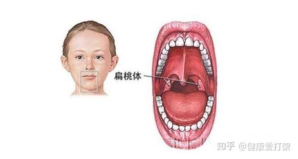 扁桃体在出现急性炎症时,扁桃体内出现充血现象,而在黏膜表面会看到