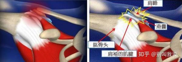 肩关节疼痛的常见六种原因你属于哪一种