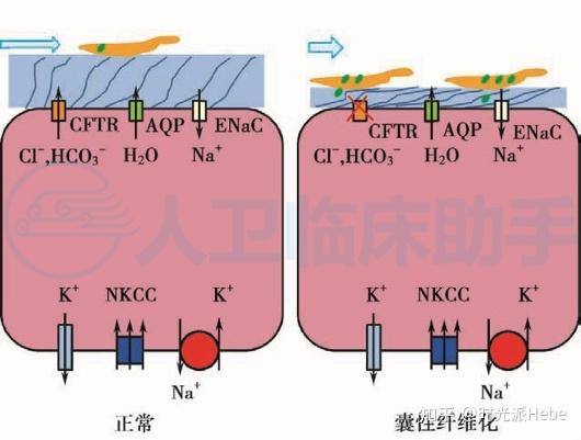 cftr结构异常导致囊性纤维化机制(图源:人民卫生出版社)