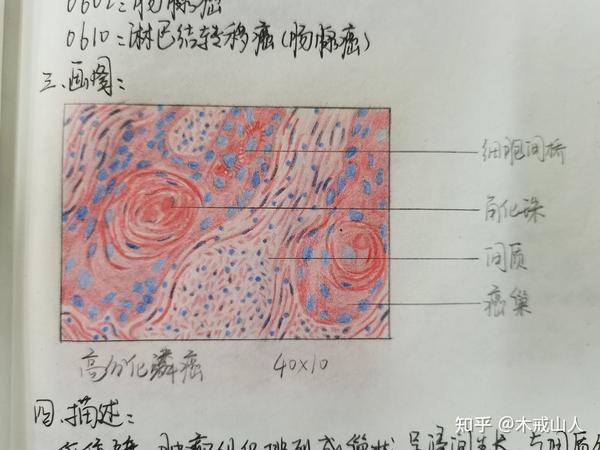 高分化鳞癌