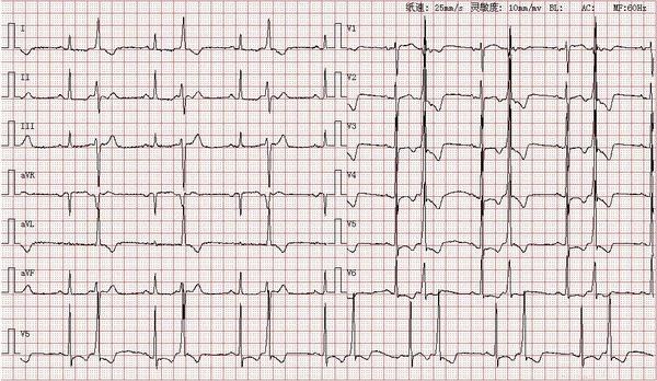 心电图图库室性早搏系列