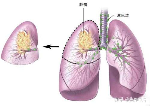 焦作中海中医肿瘤医院肺癌容易转移到哪几个部位