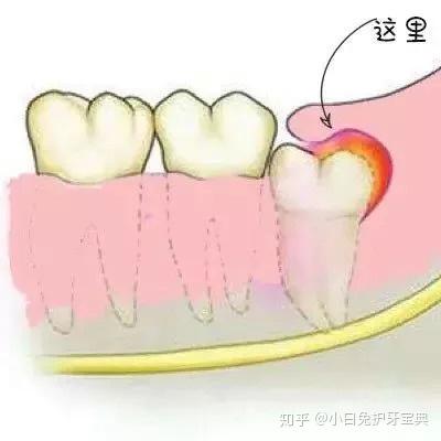 2,第二磨牙龋坏:向前倾斜的阻生智齿,经常在邻牙间积存食物,易发生邻