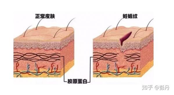 长了妊娠纹涂抹妊娠霜这些能见效吗