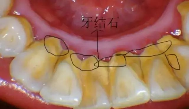 洗牙后,牙齿会脏的更快吗?