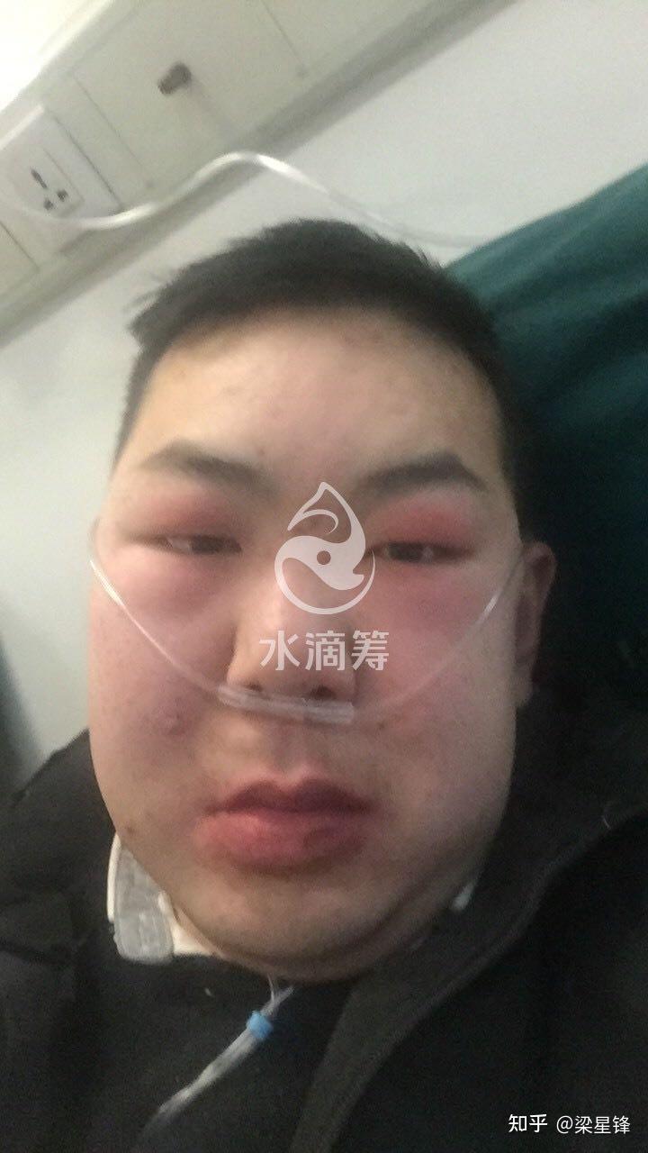 肾病综合征让我失去了所有